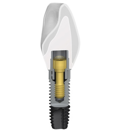 Neoss Dental Implant System